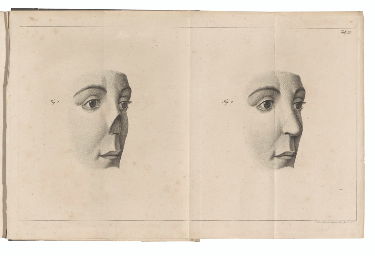 GRAEFE, Carl Ferdinand von (17871840), Rhinoplastik oder die Kunst den