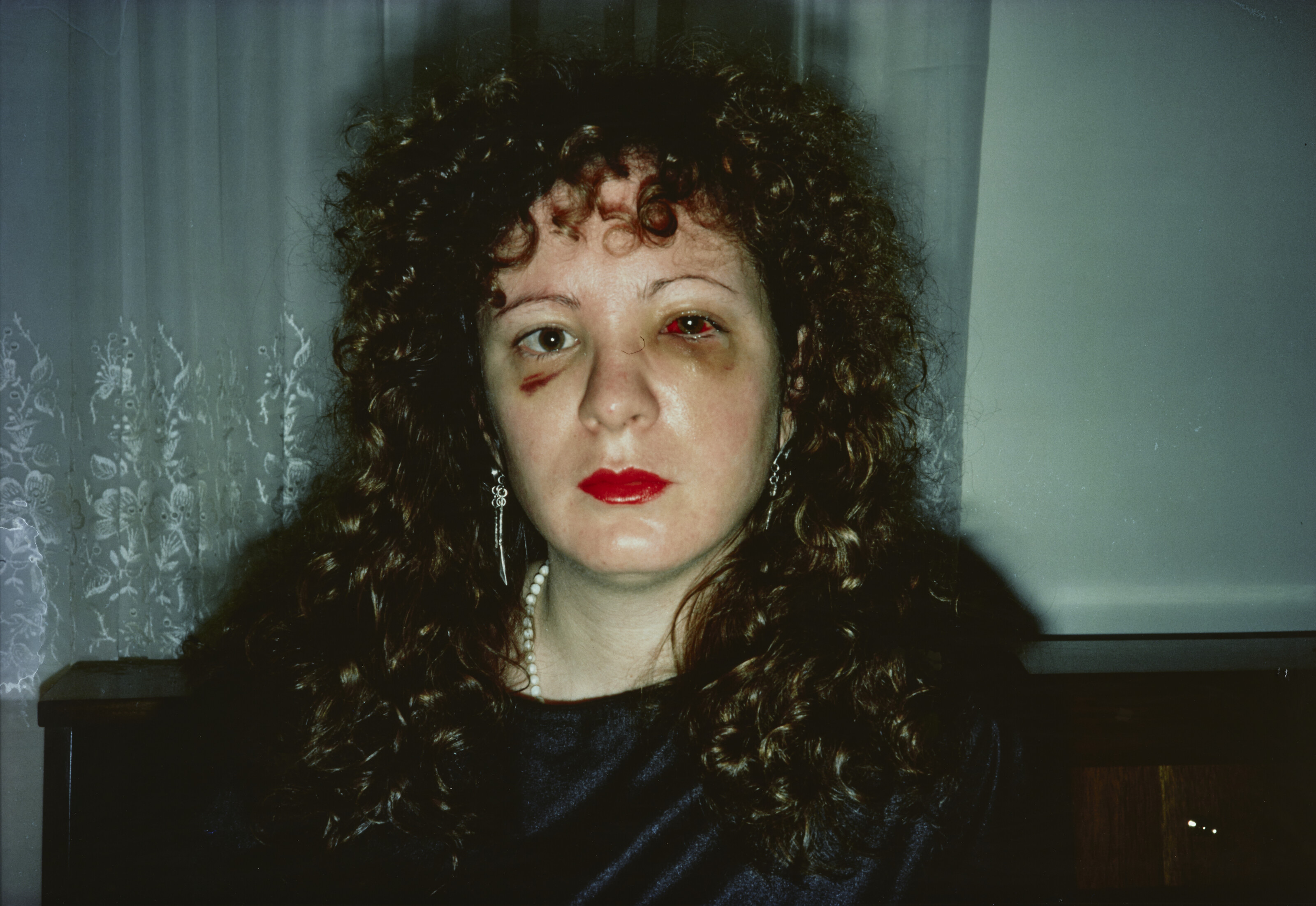 NAN GOLDIN (B. 1953), Nan after being battered, 1984