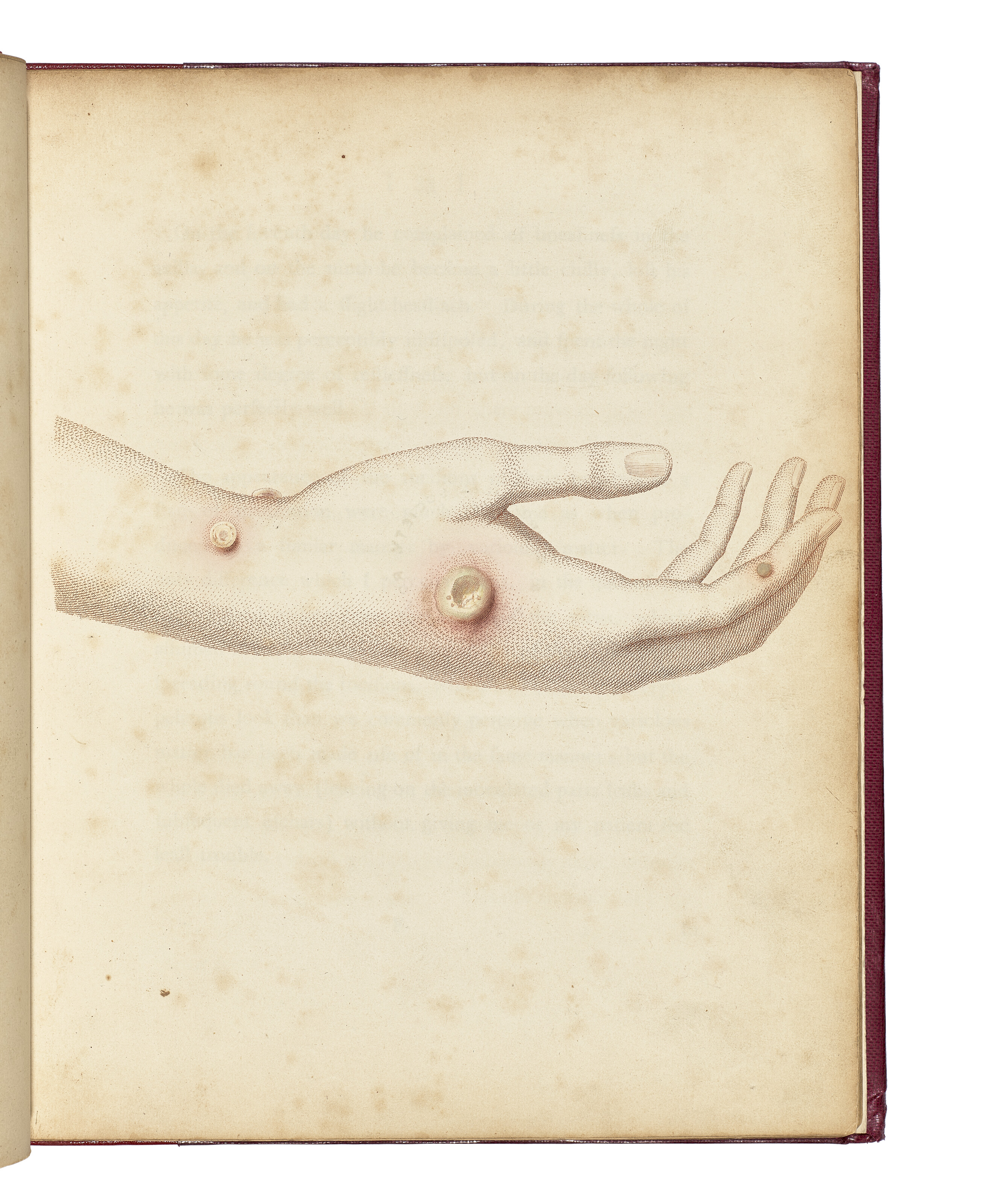 Edward Jenner, Three first editions on Variolae Vaccinae, or Cow Pox. London: 1798-1800. Jenner's work has been described as 'one of the greatest triumphs in the history of medicine' and 'the basis of the modern science of immunology,, offered in Valuable Books, Manuscripts and Photographs, including Highlights from The Royal Society of Medicine on 10 December 2025 at Christie's in London